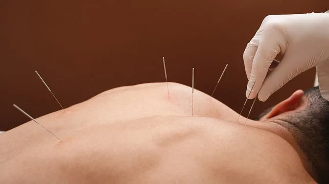 Acupuncture treatment at LivFit
